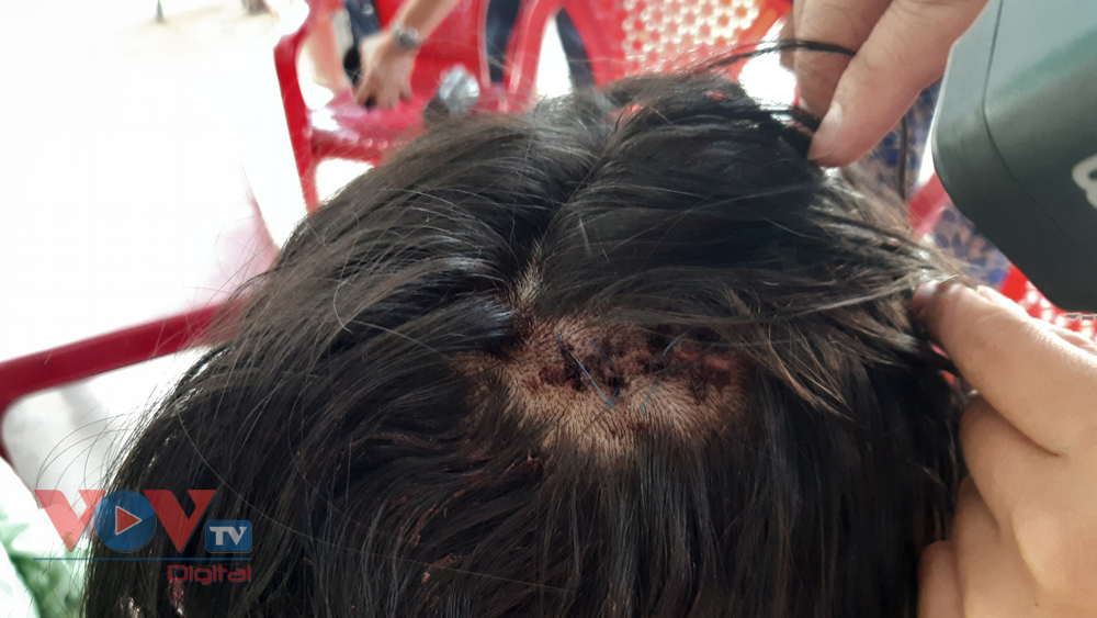 Vết thương trên đầu do hành vi côn đồ của Lê Tấn Thành gây ra với nữ sinh lớp 10 sau va chạm giao thông.jpg