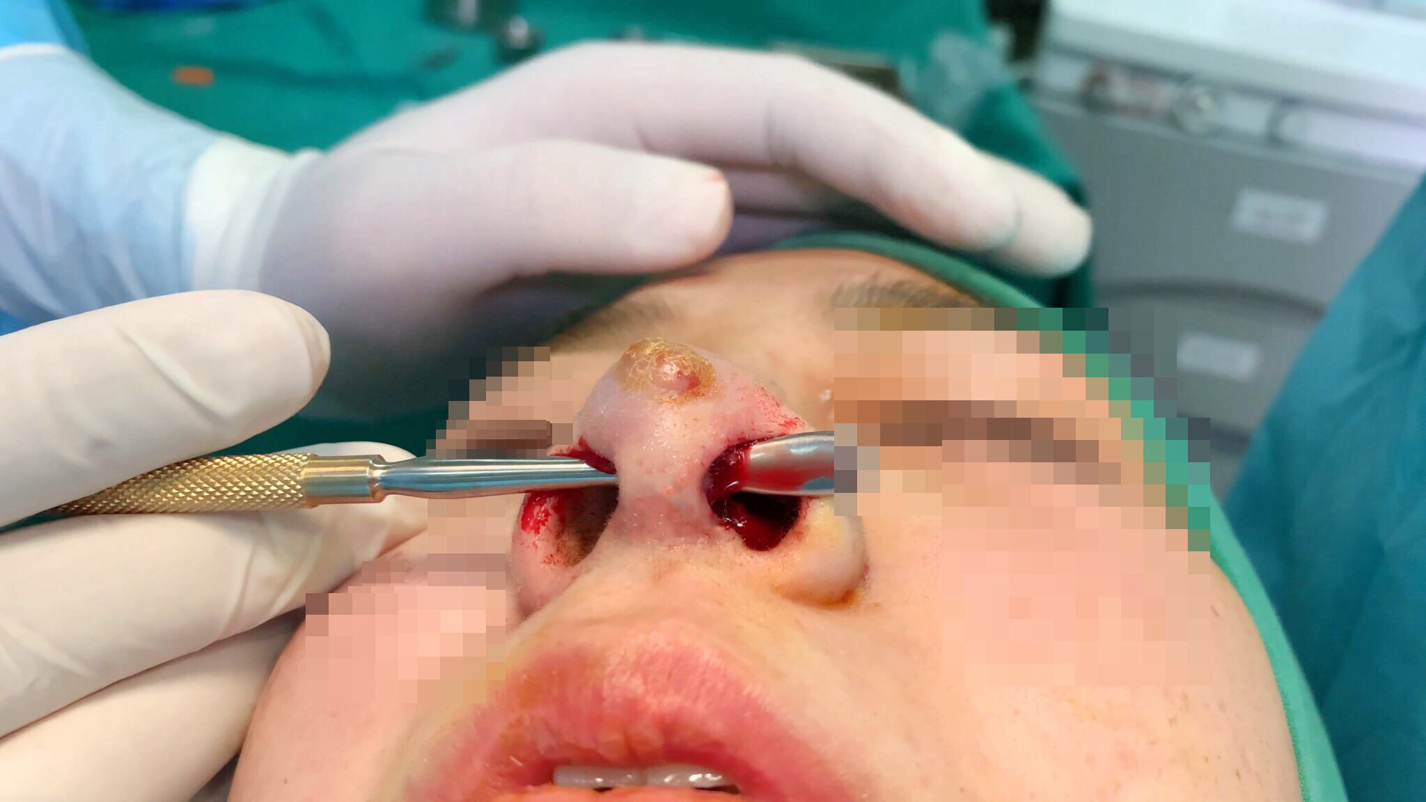Một bệnh nhân bị thủng sống mũi khi đi nâng mũi ở spa chui.jpg