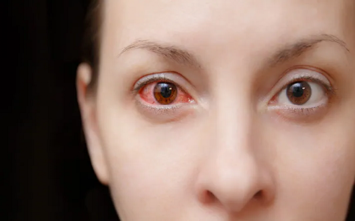 Những bệnh nhiễm trùng mắt liên quan đến COVID-19 - Ảnh 1.