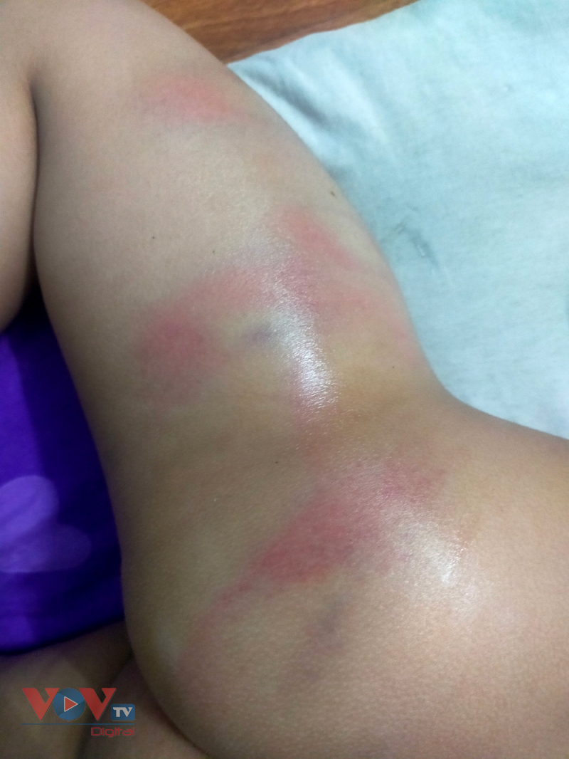 Bình Dương: Công an đang làm rõ việc bé gái 4 tuổi bị chủ nhóm trẻ đánh bầm tím người - Ảnh 3.