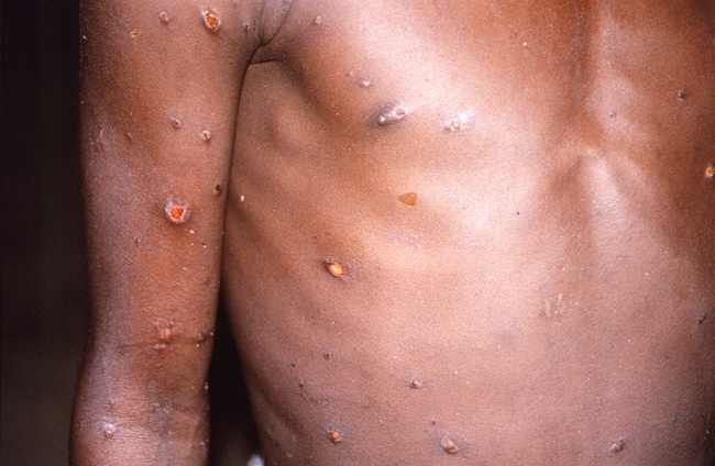 CDC châu Phi phủ nhận mối liên hệ giữa quan hệ tình dục đồng tính nam và bệnh đậu mùa khỉ - Ảnh 1.