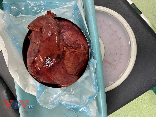 TPHCM: Phẫu thuật lấy khối u đầu tụy nặng 2,2kg hiếm gặp trên thế giới - Ảnh 2.