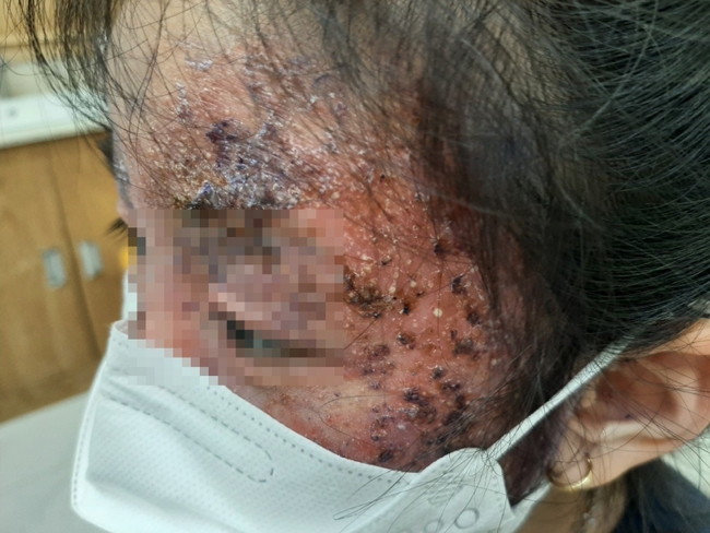 Tự điều trị nấm da, bé gái 8 tuổi tổn thương nửa khuôn mặt - Ảnh 2.