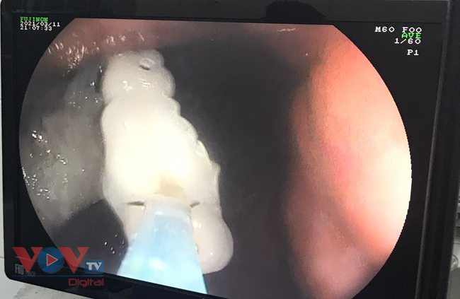 Hình ảnh răng giả qua nội soi của bệnh nhân V.T.T, 61 tuổi.jpg
