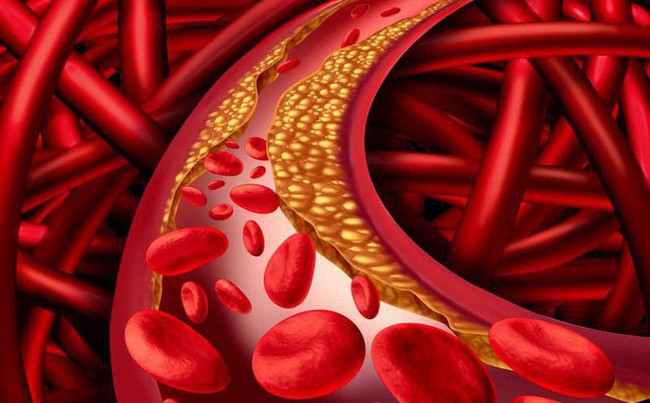 Những điều cần biết về Cholesterol - Ảnh 1.