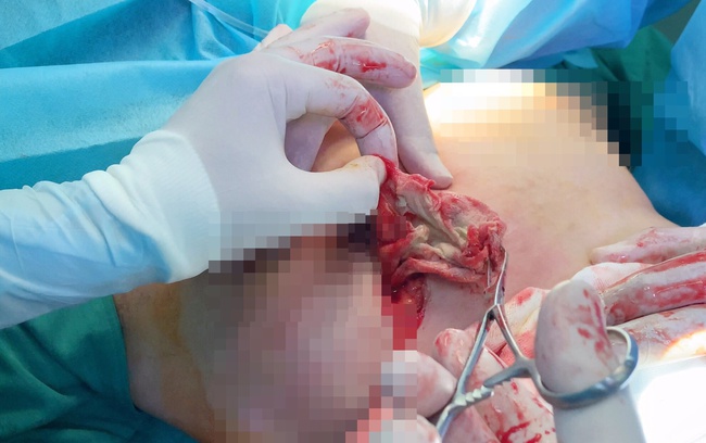 Nữ bệnh nhân phải cấp cứu vì miếng gạc y tế bị quên trong khoang ngực - Ảnh 2.