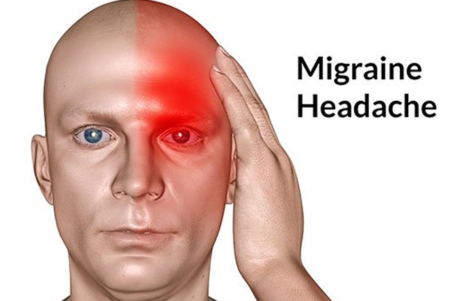 Đau đầu Migrain một bệnh lý không hề đơn giản - Ảnh 2.