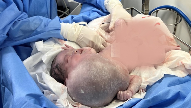 TP.HCM: Mổ thành công khối bướu khổng lồ hiếm gặp ở trẻ sơ sinh 3 ngày tuổi - Ảnh 1.