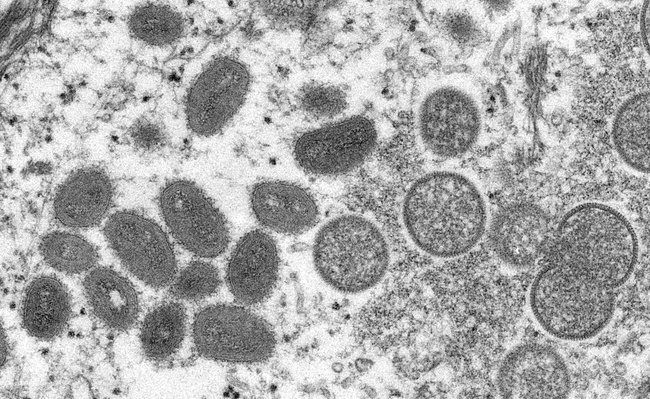 Mỹ xác nhận ca đầu tiên tử vong chắc chắn do bệnh đậu mùa khỉ ​ - Ảnh 1.