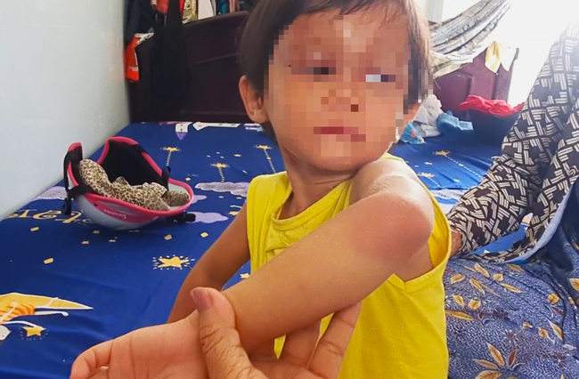Cà Mau: Bảo vệ khẩn cấp bé 4 tuổi bị cha nuôi đánh sưng phù mặt - Ảnh 1.