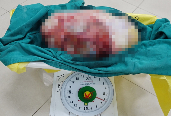 Quảng Ninh: Cắt khối u hơn 6kg trong bụng cô gái 28 tuổi - Ảnh 1.