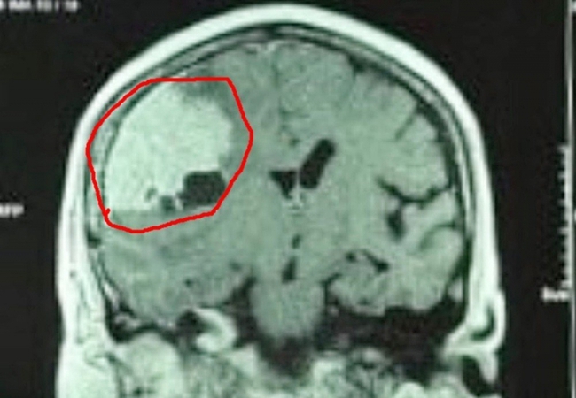 Đau đầu kéo dài, vào viện khám phát hiện khối u màng não khổng lồ - Ảnh 1.