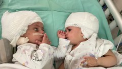 Israel: Hai bé gái sinh đôi dính liền lần đầu tiên được nhìn thấy mặt nhau
