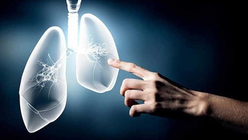 Sức khỏe cho mọi nhà: Ung thư phổi có phòng ngừa được không?