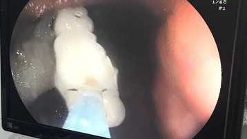 Can thiệp thành công lấy 4 chiếc răng giả lạc trong dạ dày của bệnh nhân