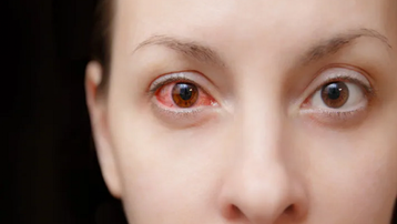 Những bệnh nhiễm trùng mắt liên quan đến COVID-19