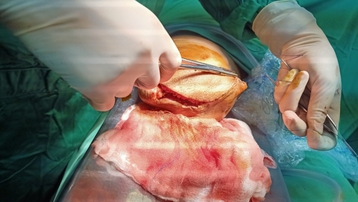 Đắk Lắk: Phẫu thuật nối thành công một trường hợp tự cắt dương vật