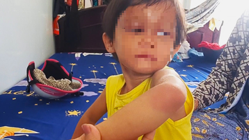 Cà Mau: Bảo vệ khẩn cấp bé 4 tuổi bị cha nuôi đánh sưng phù mặt
