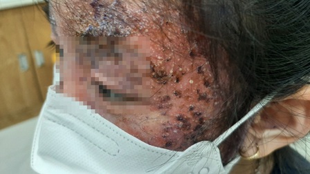 Tự điều trị nấm da tại nhà, bé gái 8 tuổi tổn thương nửa khuôn mặt