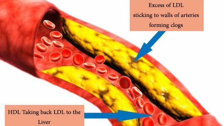 Sự khác nhau giữa LDL cholesterol và HDL cholesterol