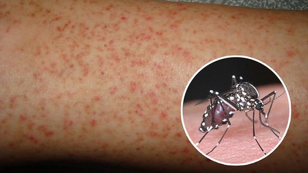 Virus Dengue - Thủ phạm gây ra sốt xuất huyết