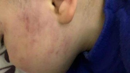 Bé trai 2 tuổi bị giáo viên tát bầm tím một bên má