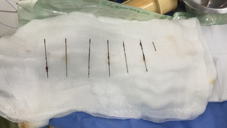 Phẫu thuật hy hữu lấy 7 cây kim gỉ sét trong lồng ngực bệnh nhân