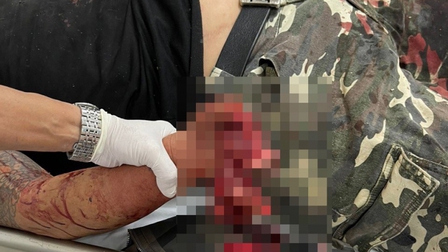 Người đàn ông ở Bình Phước bị pháo nổ dập nát tay