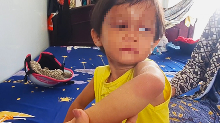 Cà Mau: Bảo vệ khẩn cấp bé 4 tuổi bị cha nuôi đánh sưng phù mặt