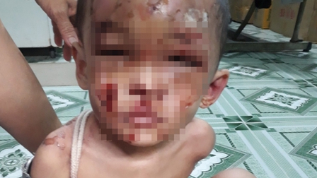 Bé trai khoảng 1 tuổi chi chít vết thương trên người, nghi bị cha mẹ bạo hành