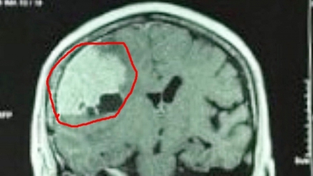 Đau đầu kéo dài, vào viện khám phát hiện khối u màng não khổng lồ