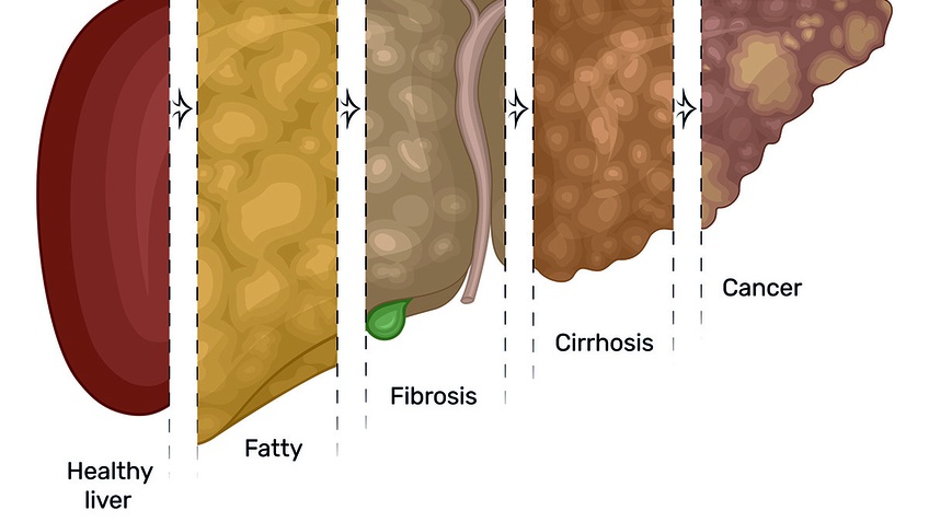Cảnh báo số ca tử vong trên thế giới do ung thư gan sẽ tăng mạnh