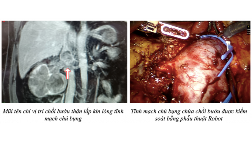 TP.HCM: Đơn vị đầu tiên của cả nước sử dụng robot cắt thận và lấy chồi bướu ung thư